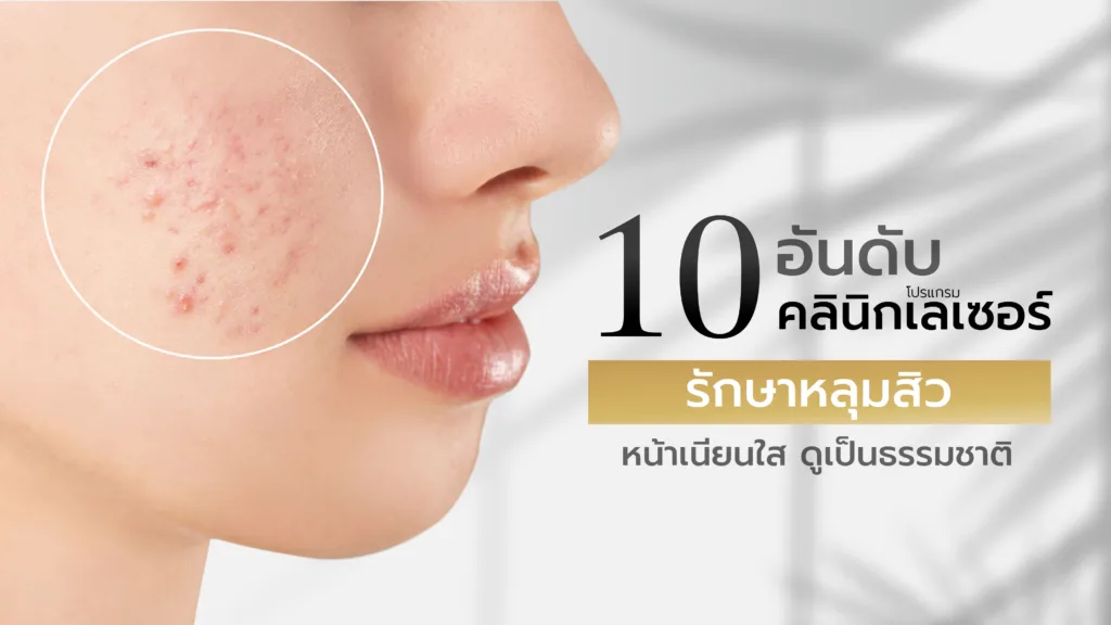 10 อันดับ คลินิกเลเซอร์รักษาหลุมสิว หน้าเนียนใสขึ้น แบบเป็นธรรมชาติ