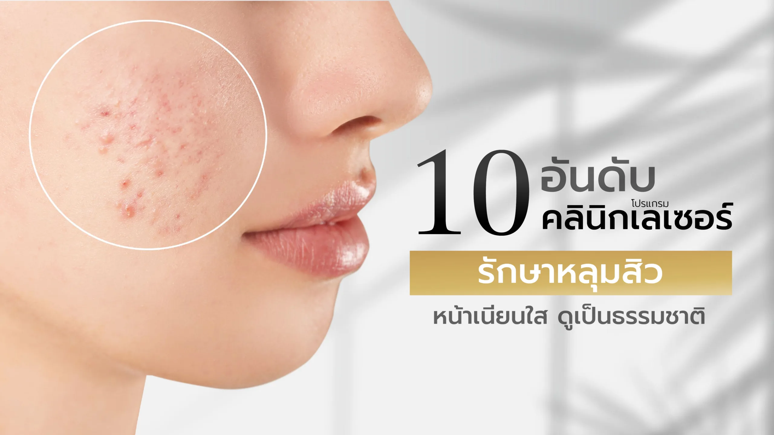 10 อันดับ คลินิกเลเซอร์รักษาหลุมสิว หน้าเนียนใสขึ้น แบบเป็นธรรมชาติ