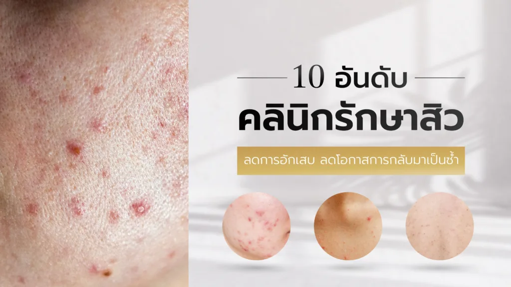 10 อันดับ คลินิกรักษาสิว ลดการอักเสบ ลดโอกาสการกลับมาเป็นซ้ำ